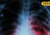 टीबी के मरीजों के लिए राहत की खबर, ट्रूनेट मशीन से होगी जांच, फ्री होगा इलाज