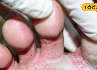 बारिश के पानी से होने वाले फंगल इन्फेक्शन से हैं परेशान, तो जल्द करें ये उपाय