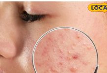 बड़ी आसानी से मिल जाती हैं ये चीजें, फोड़े-फुंसियां होने पर लगाएं,दिखेगा असर