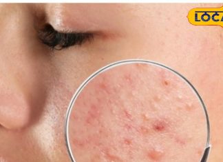 बड़ी आसानी से मिल जाती हैं ये चीजें, फोड़े-फुंसियां होने पर लगाएं,दिखेगा असर