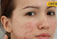 चेहरे पर कील मुंहासे से हैं परेशान तो अपनाएं यह आसान आयुर्वेदिक घरेलू उपचार