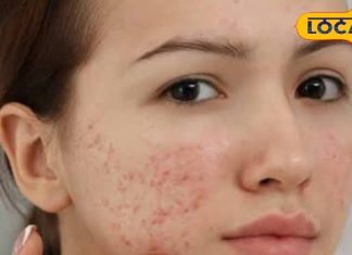 चेहरे पर कील मुंहासे से हैं परेशान तो अपनाएं यह आसान आयुर्वेदिक घरेलू उपचार