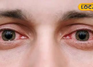 बारिश के पानी से आंखों में है जलन? इसे रगड़ने या मसलने की न करें भूल, अपनाएं ये घरेलू नुस्खे