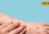 Monkey pox: मंकी पॉक्स से बचाएगी ये वैक्सीन! BHU के एक्सपर्ट ने किया बड़ा दावा-Monkey pox virus chechak vaccine will protect against monkey pox BHU expert claimed