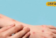 Monkey pox: मंकी पॉक्स से बचाएगी ये वैक्सीन! BHU के एक्सपर्ट ने किया बड़ा दावा-Monkey pox virus chechak vaccine will protect against monkey pox BHU expert claimed