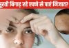 चेहरे की खूबसूरती का हो रहा सत्यानाश? माथे पर बार-बार निकल आते हैं मुहांसे? निजात पाने के लिए अपनाएं ये 5 उपाय