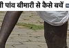 हाथी की तरह फूल जाते हैं हाथ-पांव, इस बीमारी का यूपी-बिहार में आतंक, अब सरकार ने की भगाने की तैयारी