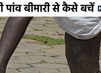 हाथी की तरह फूल जाते हैं हाथ-पांव, इस बीमारी का यूपी-बिहार में आतंक, अब सरकार ने की भगाने की तैयारी