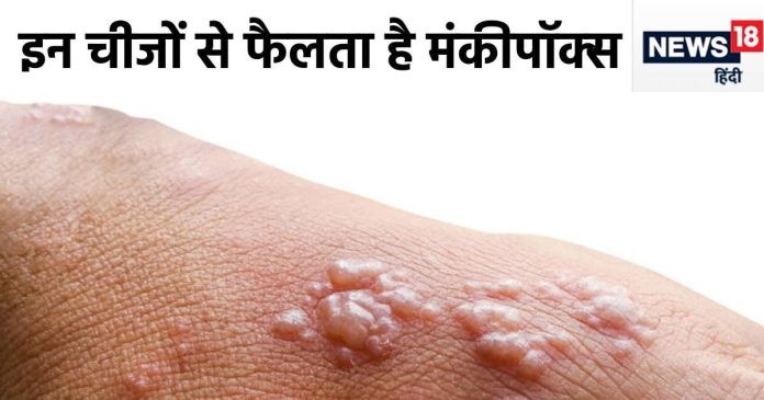 monkeypox-mpox-kaise-failta-hai-2024-08-d66ac681f3e83ca8384e2254af776d3d-16x9.jpg