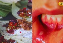 छालों के इलाज का राज या है केवल एक मिथक? जानें BHU के आयुर्वेदाचार्य से – Bharat.one हिंदी