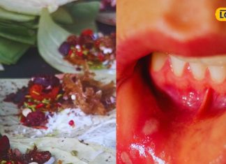 छालों के इलाज का राज या है केवल एक मिथक? जानें BHU के आयुर्वेदाचार्य से – Bharat.one हिंदी