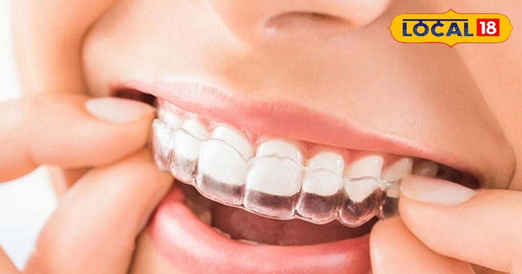 ब्रेसिज के बिना भी दे सकते हैं दांतों को सही शेप, सब देखते रह जाएंगे खूबसूरत मुस्कुराहट