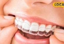 ब्रेसिज के बिना भी दे सकते हैं दांतों को सही शेप, सब देखते रह जाएंगे खूबसूरत मुस्कुराहट