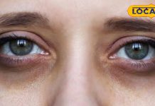 डार्क सर्कल की हो जाएगी छुट्टी, चेहरे पर आएगा निखार, बस डाइट में करें यह बदलाव