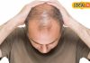 Prevent Hair Fall: तेजी से झड़ रहे हैं बाल, एक्सपर्ट से जानिए उपाय, नहीं होंगे गंजेपन का शिकार