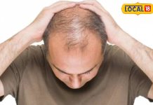 Prevent Hair Fall: तेजी से झड़ रहे हैं बाल, एक्सपर्ट से जानिए उपाय, नहीं होंगे गंजेपन का शिकार