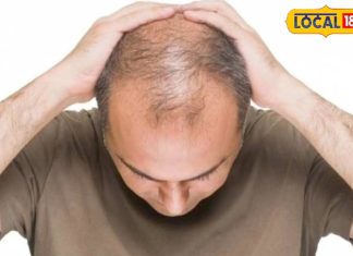 Prevent Hair Fall: तेजी से झड़ रहे हैं बाल, एक्सपर्ट से जानिए उपाय, नहीं होंगे गंजेपन का शिकार