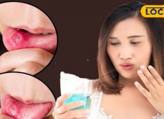 मुंह में होने वाले छालों से पाएं छुटकारा, आजमाएं ये घरेलू उपाय; नहीं करना पड़ेगा परेशानियों का सामना – Bharat.one हिंदी