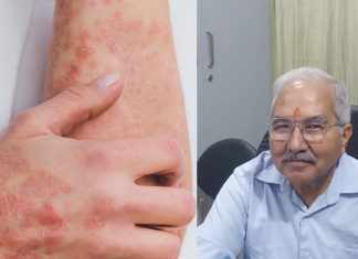 Psoriasis is an autoimmune disease it spreads rapidly due to stress method of treatment