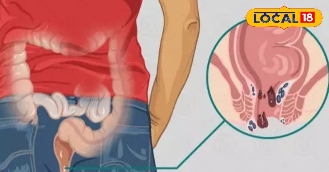 Piles Treatment: क्षार सूत्र से खत्म होगी बवासीर बीमारी, जानें लक्षण-कारण और इलाज