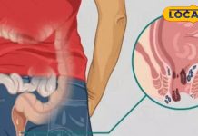 Piles Treatment: рдХреНрд╖рд╛рд░ рд╕реВрддреНрд░ рд╕реЗ рдЦрддреНрдо рд╣реЛрдЧреА рдмрд╡рд╛рд╕реАрд░ рдмреАрдорд╛рд░реА, рдЬрд╛рдиреЗрдВ рд▓рдХреНрд╖рдг-рдХрд╛рд░рдг рдФрд░ рдЗрд▓рд╛рдЬ