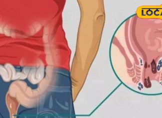 Piles Treatment: क्षार सूत्र से खत्म होगी बवासीर बीमारी, जानें लक्षण-कारण और इलाज