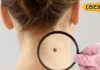 Skin Cancer: त्वचा पर दिखें ये बदलाव तो सावधान! ऑन्कोलॉजिस्ट से जानें स्किन कैंसर के लक्षण और बचाव के तरीके