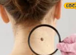 Skin Cancer: त्वचा पर दिखें ये बदलाव तो सावधान! ऑन्कोलॉजिस्ट से जानें स्किन कैंसर के लक्षण और बचाव के तरीके