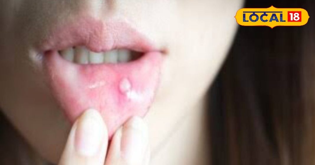 मुंह के छालों से परेशान हैं? आजमाएं ये घरेलू उपाय, हफ्ते भर में मिलेगी राहत