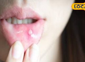 मुंह के छालों से परेशान हैं? आजमाएं ये घरेलू उपाय, हफ्ते भर में मिलेगी राहत