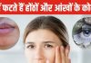 अगर होंठ और आंखों के कोने फट रहे हैं तो इसे ड्राइनेस समझने की भूल ना करें, यह बीमारी हो सकती है