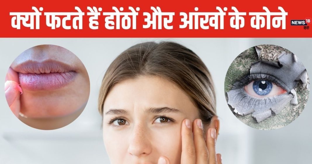 अगर होंठ और आंखों के कोने फट रहे हैं तो इसे ड्राइनेस समझने की भूल ना करें, यह बीमारी हो सकती है