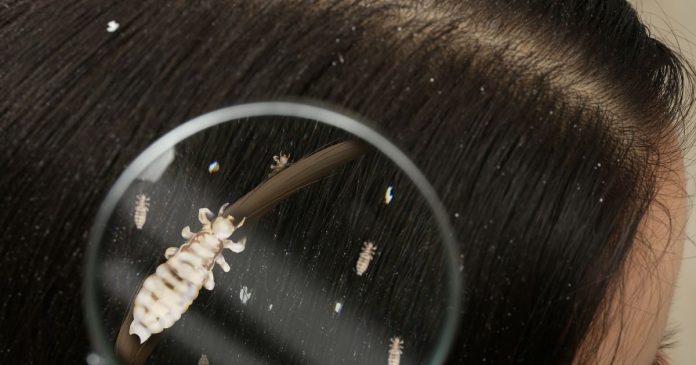 अचानक सिर में पड़ गए हैं सफेद जूं, नजरअंदाज न