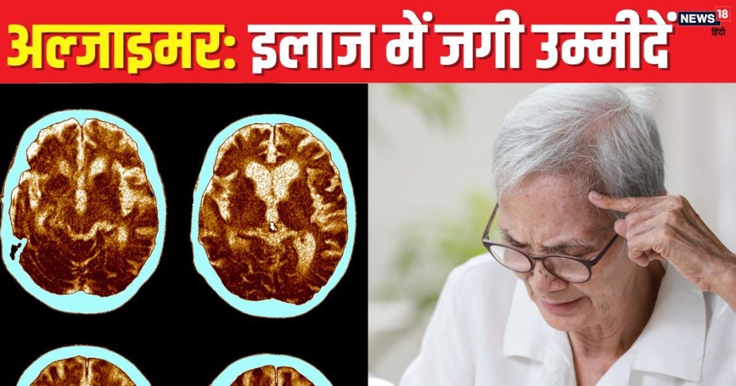 अल्जाइमर के इलाज में जगी उम्मीद, चीनी वैज्ञानिकों ने ब्रेन प्रोटीन वेस्ट क्लीन करने वाली सर्जरी में पाई सफलता