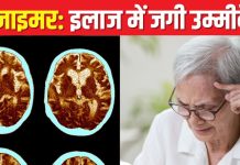 अल्जाइमर के इलाज में जगी उम्मीद, चीनी वैज्ञानिकों ने ब्रेन प्रोटीन वेस्ट क्लीन करने वाली सर्जरी में पाई सफलता