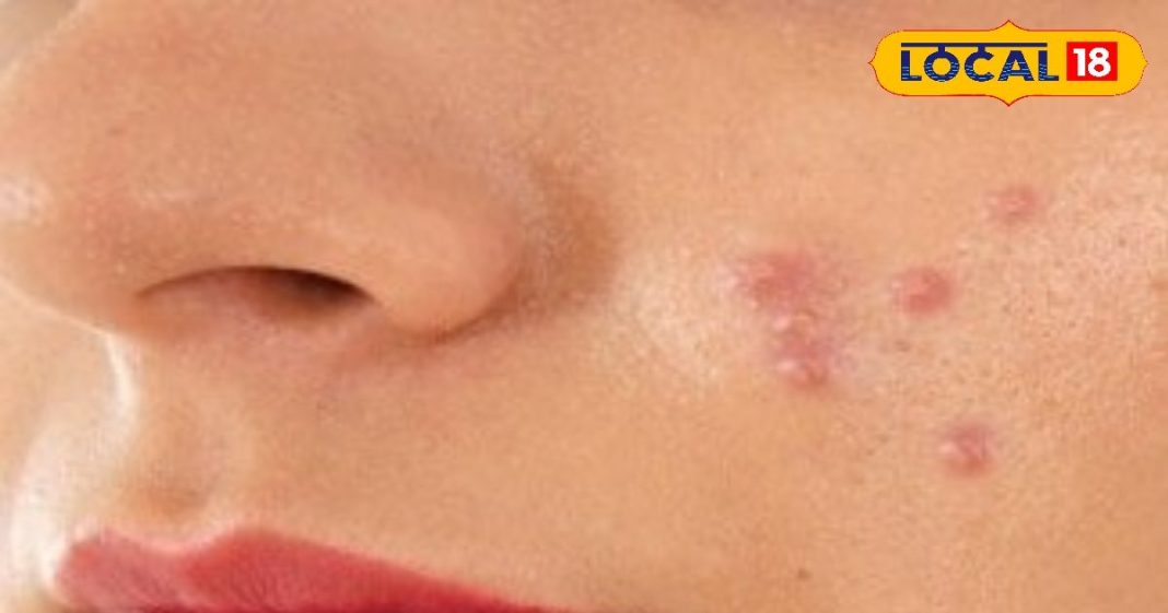 फंक्शन के दो दिन पहले चेहरे पर निकले पिंपल्स तो क्या करें? 3 आसान तरीके से तुरंत मिलेगा आराम