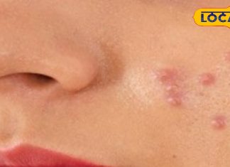 फंक्शन के दो दिन पहले चेहरे पर निकले पिंपल्स तो क्या करें? 3 आसान तरीके से तुरंत मिलेगा आराम