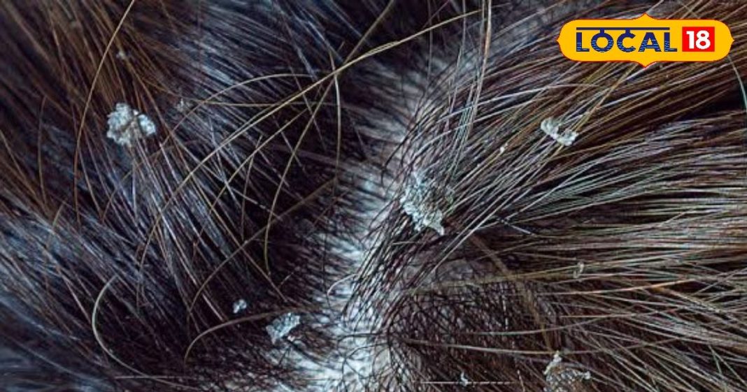 Eliminate dandruff in pinch with this Ayurvedic formula in winter – Bharat.one हिंदी