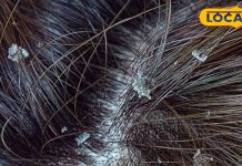 Eliminate dandruff in pinch with this Ayurvedic formula in winter – Bharat.one हिंदी