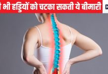 आपकी जिंदगी से कई साल छीन लेगी हड्डियों की यह साइलेंट बीमारी, बोन फ्रेक्चर से बचने के ये हैं उपाय