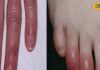 हाथ-पैर की सूजी उंगलियां हो सकती है बड़ा खतरा! भूल से भी न करें ये गलतियां