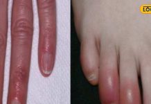 हाथ-पैर की सूजी उंगलियां हो सकती है बड़ा खतरा! भूल से भी न करें ये गलतियां
