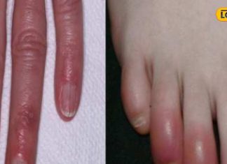 हाथ-पैर की सूजी उंगलियां हो सकती है बड़ा खतरा! भूल से भी न करें ये गलतियां