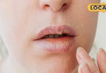 एक्सपर्ट द्वारा जाने सर्दियों में फटे हुए होंठ को हेल्दी रखने का टिप्स.<br>