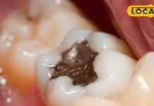 If there is a cavity in your teeth then don’t worry, you can get rid of it by using these things – Bharat.one हिंदी