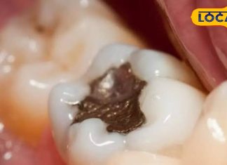 If there is a cavity in your teeth then don’t worry, you can get rid of it by using these things – Bharat.one हिंदी