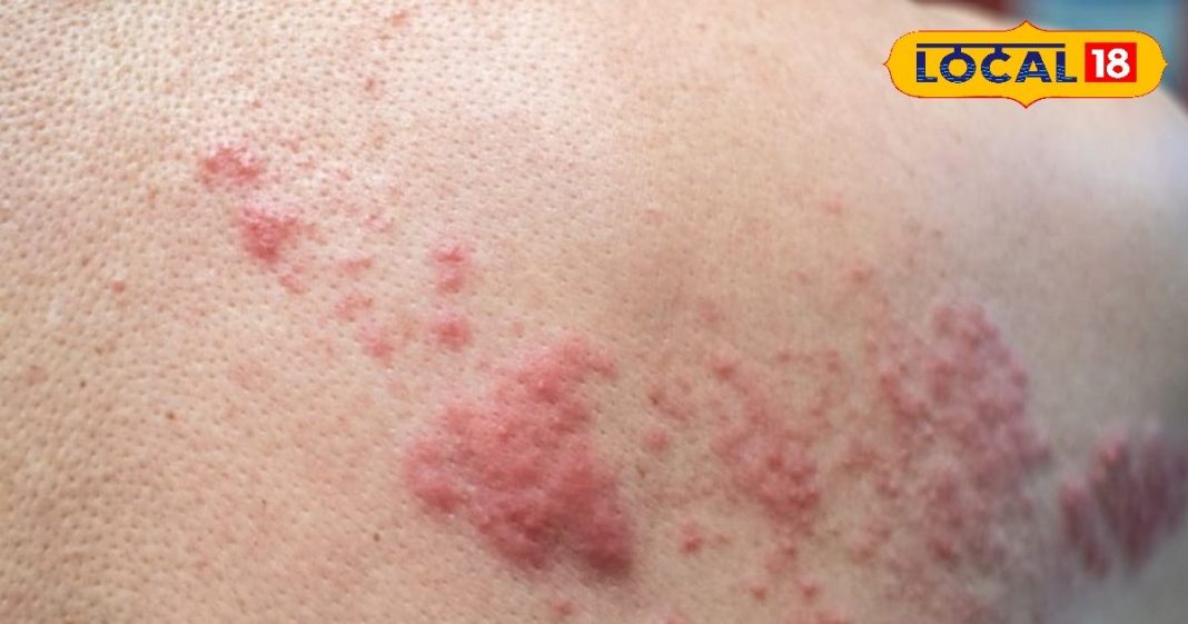 सावधान हो जाएं! सर्दियों में इस बीमारी से शरीर और मुंह पर निकल रहे लाल दाने, 6 महीने तक रहता है असर