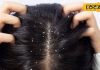 Dandruff Home Remedies: डैंड्रफ से परेशान हैं तो ये रहा कारगर घरेलू नुस्खा, रूसी खत्म करने की गारंटी!