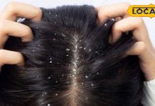 Dandruff Home Remedies: डैंड्रफ से परेशान हैं तो ये रहा कारगर घरेलू नुस्खा, रूसी खत्म करने की गारंटी!