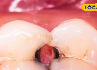 अगर आप दांतों में लगे कीड़े से परेशान हैं तो देसी नुस्खे अपनाकर मिनटों में बाहर निकाले, जानिए